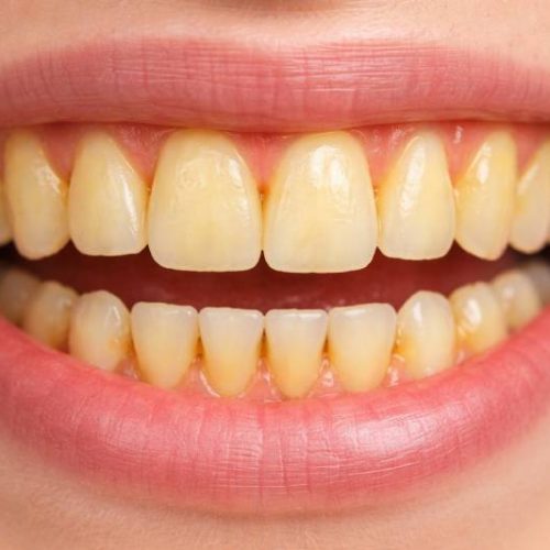 Yellow Teeth Home Remedies