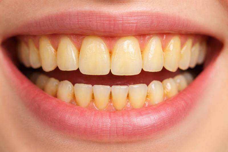 Yellow Teeth Home Remedies